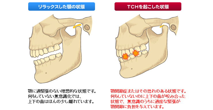 TCH（歯列接触癖）