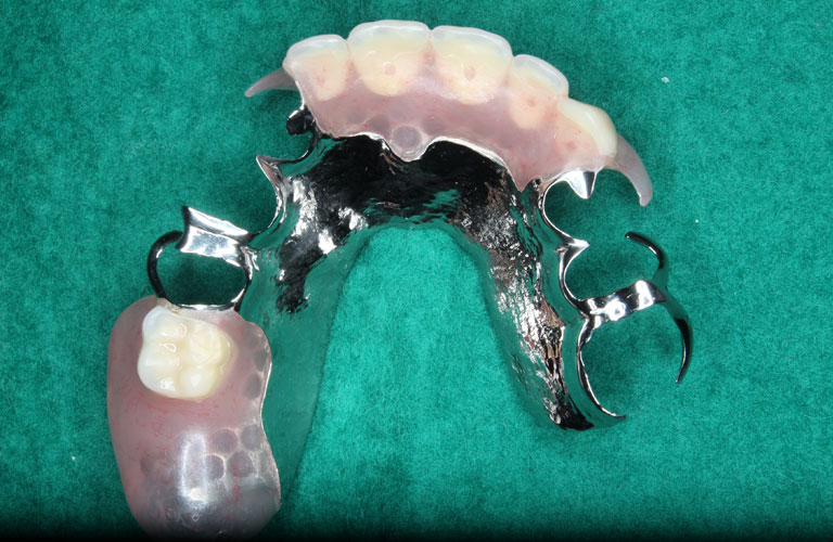 エステショット症例4 製作したエステショット義歯